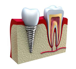 Zahnersatz mit Zahnimplantate