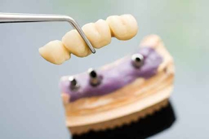 Zahnbrücke auf Implantat